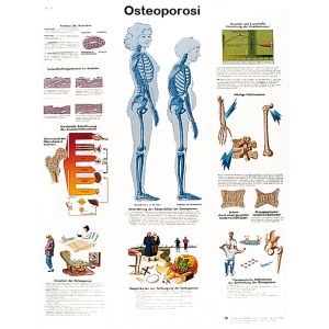 POSTER OSTEOPOROSI