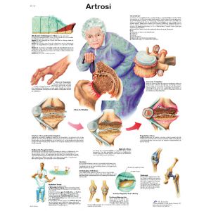 POSTER ARTROSI