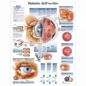 POSTER MALATTIE DELL'OCCHIO