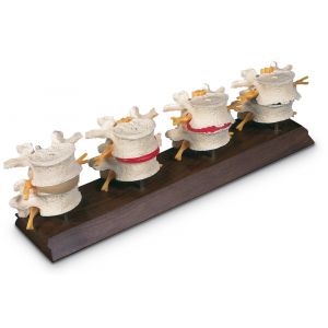 SET LOMBARE DEGENERATIVO IN 4 STADI